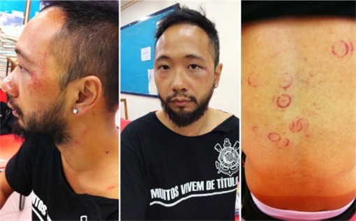 Hong Kong Police Beat Protester Ken Tsang - Ken Tsang Injury - 1