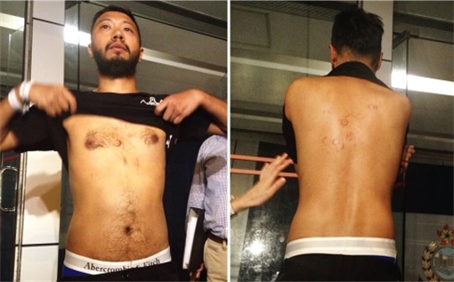 Hong Kong Police Beat Protester Ken Tsang - Ken Tsang Injury - 2