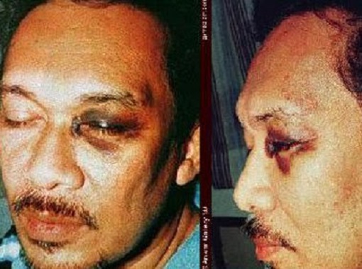 Anwar Ibrahim - Beaten Black Eye